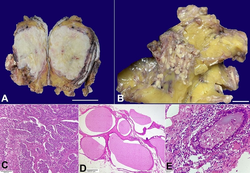 A &ndash; gross examination from the first lesion reveals large, well-defined solid, greyish white firm tumour of 8.5x6.5x4.0 cm (scale bar= 3 cm); B &ndash; gross examination from the second lesion shows multiple variable-sized yellowish-white nodules of 1.0 mm to 10.0 mm (scale bar 1 cm); C &ndash; photomicrograph from the solid tumour shows a cellular invasive tumour arranged in solid trabecular and sheet-like architecture with marked nuclear anaplasia and focal necrosis (H&E 100X); D &ndash; photomicrograph from the second lesion shows multiple cystically dilated spaces lined by cuboidal epithelium and filled with homogeneous eosinophilic colloid-like material with few macrophages, indicating CHH (H&E, 40X); E &ndash; photomicrograph shows CHH with nuclear atypia and epithelial multilayering (H&E 400X).