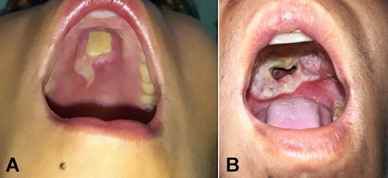 Oral cavity examination during initial hospital visits showing in A - an ulcer in the hard palate covered with yellowish slough, and in B - Deep ulcers with perforation and well-defined erythematous, edematous margins (B) were seen during later outpatient department (OPD) visits and during hospital admission.
