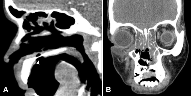 Contrast-enhanced Computed tomography showing in A - punched-out mucosal ulceration in the inferior and superior aspects of the hard palate (white arrowhead), and in B - Soft tissue thickening along the right lateral margin of the ulcer with rarefactions and erosions of adjacent bone (black arrowhead).