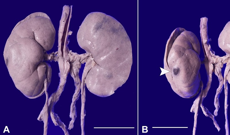 Gross photograph of bilateral kidneys showing in A - blotchiness and blackish nodular lesions on the capsular surface (scale bar 4 cm), B - Nodules are hemorrhagic with central necrosis on closer examination (scale bar 6 cm) (white arrowhead).