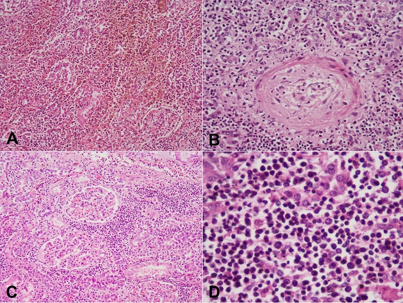 Photomicrography of the kidney lesion showing in A - hemorrhage, debris, and lymphoid cells in the tubulointerstitial compartment, B - with evidence of vasculitis in one of the interlobular arteries; C - Lymphoid cells are insinuating in between the tubules and D - have an irregular nuclear membrane, folded hyperchromatic nuclei, and a moderate amount of pale cytoplasm.