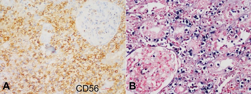 Photomicrographs of the kidney lesion. A - immunohistochemistry (IHC), lymphoid infiltrates show intense membranous positivity for CD 56; B - In-situ hybridization for EBV-encoded RNA (EBER) exhibits the presence of Epstein-Barr virus in most of the lymphoma cells.