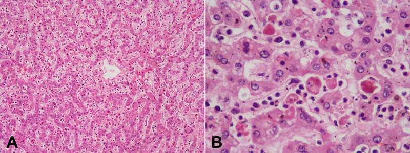 Photomicrographs of the liver show in A - sinusoidal infiltration by lymphoma cells; B - significant increase in the number of histiocytes showing hemophagocytosis (B). (H&E; A - 100x; B - 400x).