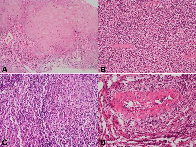 Photomicrographs antemortem biopsies showing in A - pseudo-epitheliomatous hyperplasia; B - granulation tissue with dense inflammation; C - vague granuloma formation; D - arteritis (H&E, A to C 200X, D 400X).