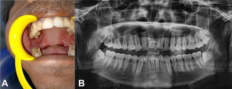A - intraoral photograph revealing ulceroproliferative lesion on right pterygomandibular raphe; B - orthopantogram without soft tissue or bony changes.