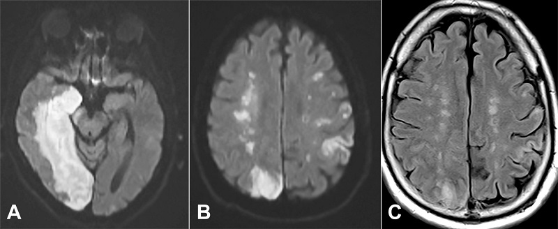 Magnetic resonance imaging from hospital day 4. A - the acute large right posterior cerebral artery infraction is seen affecting the right medial temporal lobe and occipital lobe on the diffusion weighted imaging; B - at the upper border of the right parieto-occipital cortical infarction, one can see a string of bright areas in the deep centrum semiovale on the right side representing acute watershed infarction on this diffusion weighted image. Acute cortical strokes are seen in the left hemisphere; C - the fluid attenuated inversion recovery (FLAIR) scan confirms the deep watershed infarctions bilaterally, seen as higher signal intensity on this imaging. The visualization on FLAIR suggests the infarctions are over 6 hours old. Diffusion weighted imaging remain positive for 7-15 days.
