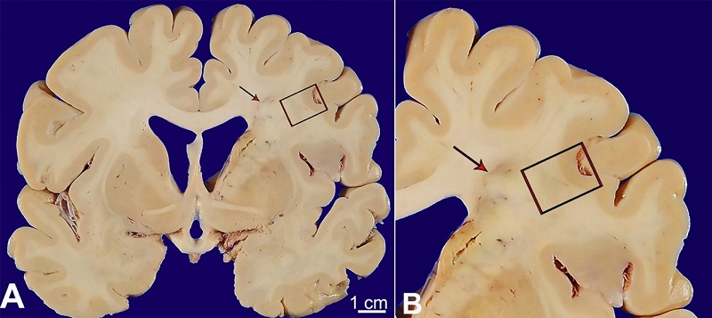 A and B - gross and microscopic pathology of internal watershed infarct; A - a confluent, “cigar-shaped” lesion involving the right hemispheric deep white matter was identified at the time of brain cutting (red arrow). This lesion extended from the frontal pole to the parieto-occipital lobe.