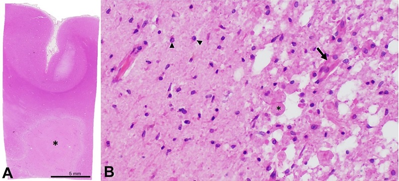 Microphotographs of the Brain - A - low-magnification photograph of representative section of the lesion (asterisk) and overlying cortex (section taken from area of red box from panel A); B - representative histology of the interface between the lesion demonstrating a necrotic core with infiltrating macrophages (asterisk) and neovascularization (arrow) as well as adjacent reactive glial tissue (arrowheads) (A - H&E; B - H&E, 200x).