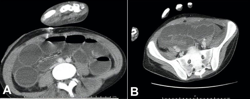 A &ndash; Non-contrasted abdominal computerized tomography showing dilated loops of bowel measuring 11 cm at maximum in the cecum and ascending colon; B - Non-contrasted pelvic computerized tomography showing abnormal bowel wall thickening with a maximum bowel thickness of 1.2 cm in the ascending colon.