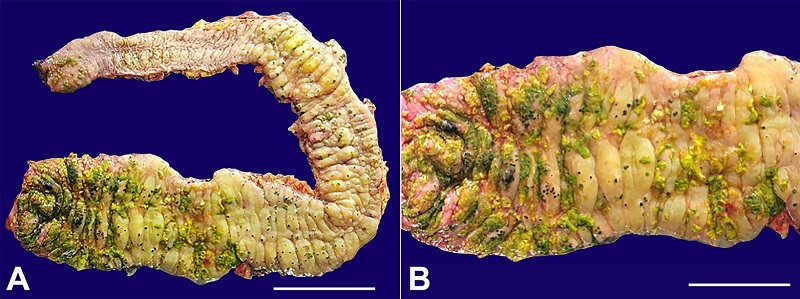 A and B - Gross view of the resected colon showing yellow-green plaques (pseudomembranes) adherent to the mucosal surface predominantly in the cecum and the right colon.