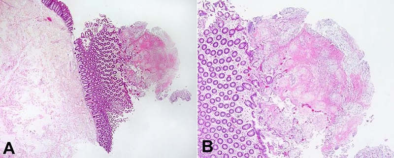 A and B - Histopathologic features of the resected colon: type I lesion, characterized by superficial mucosal necrosis with an erupting spray of fibrinopurulent exudate [H&E, 100x (A), 200x (B)].