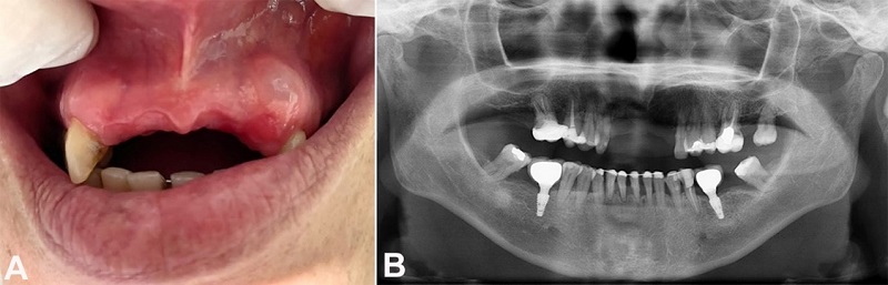 A - Gross view of the oral examination showing a translucent nodule in the upper left gingiva, near tooth #11, measuring approximately 6mm; B - Panoramic radiographic without evident lesions.