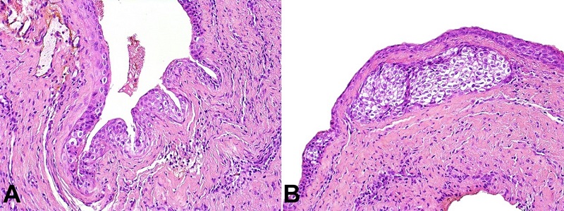 Histopathological findings of the biopsy. A and B - Multiple cystic cavities lined by squamous epithelium of varying thickness with focal areas of nodular thickenings. The presence of clusters of cells with clear cytoplasm within epithelial thickenings was observed (H&E, 200x).