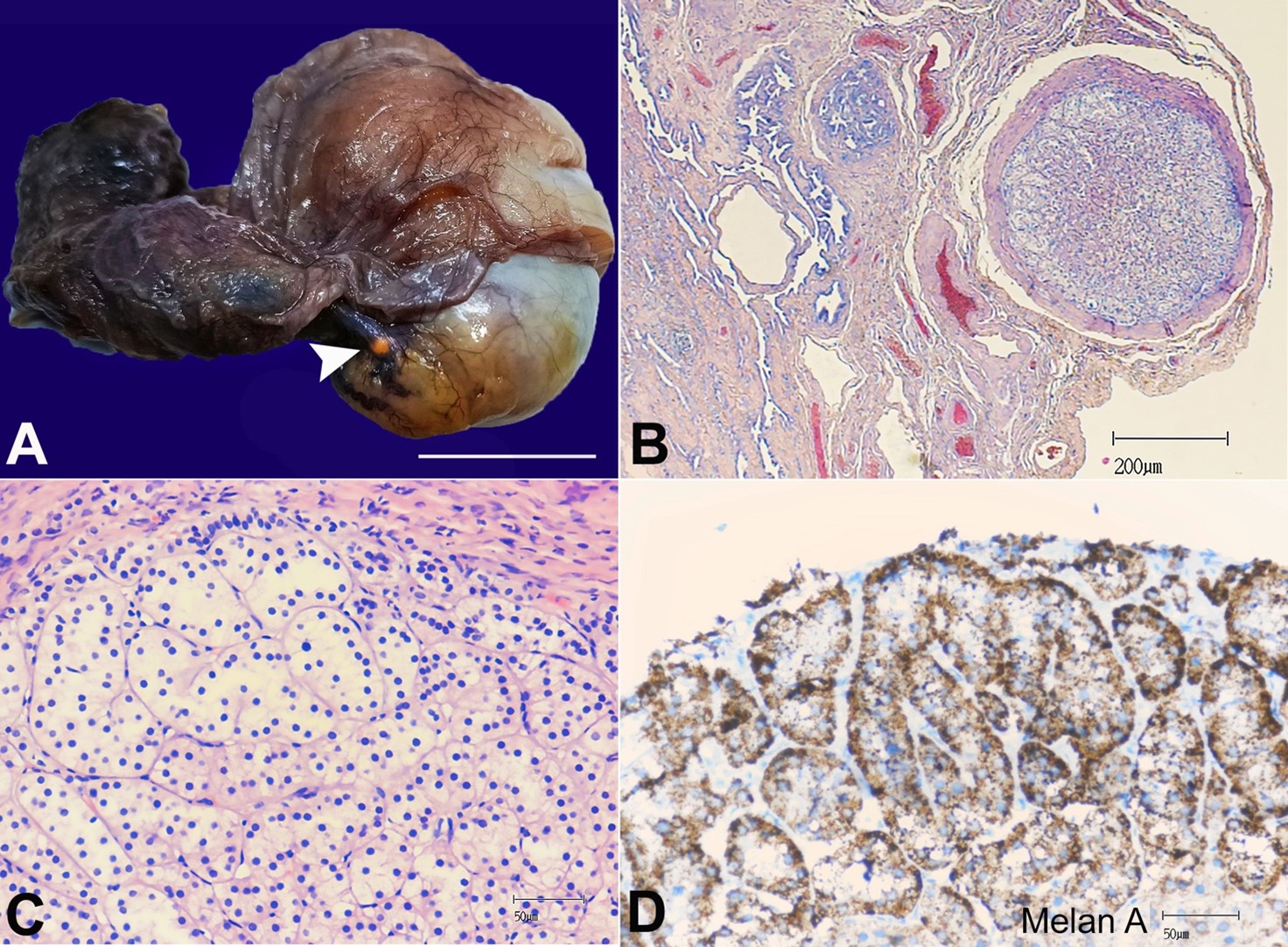 A - Gross orchiectomy specimen displaying a tiny nodule yellowish-brown in color (arrowhead) below the visceral layer of the tunica vaginalis and close to the head of the epididymis (scale bar= 3 cm); B - Encapsulated adrenal rest located between epididymis and rete testis; C - Encapsulated adrenal cortical tissue; D - Immunohistochemical positivity for Melan-A.