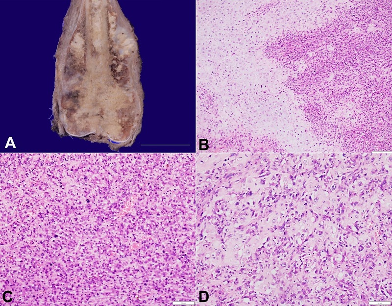 A &ndash; Gross view of the resected femur showing a grey-white infiltrative tumor involving the lower end of the femur, causing periosteal elevation and intramedullary extension. The mucoid to homogenous white areas represent the cartilaginous islands with intervening calcification (scale bar = 12cm); B &ndash; Photomicrograph showing permeative cellular tumor (right) condensing at cartilaginous islands (left) (H&E; x100); C &ndash; Pleomorphic tumor cells with brisk mitosis (H&E; x200); D &ndash; Malignant lacy osteoid permeating the markedly atypical cartilaginous cells (H&E; x200).