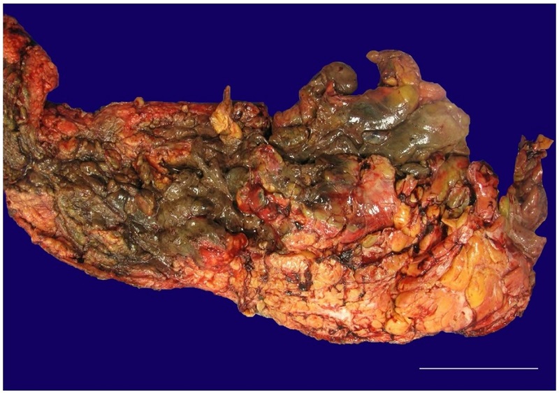 Gross pathologic examination of the debrided necrotic tissue measuring 44 &times; 17 &times; 4 cm (scale bar = 5 cm).