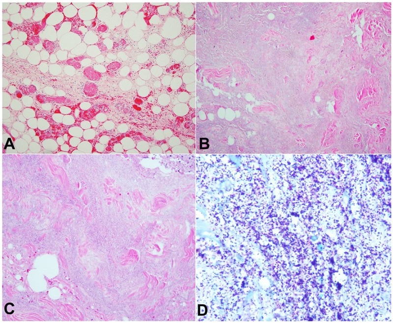 Photomicrograph of the surgical specimen. A &ndash; displays fat necrosis with fibrin thrombi in the blood vessels (H&E, 200X); B &ndash; displays pale gray necrotic tissue having a granular appearance without associated neutrophils consistent with stage III necrotizing fasciitis (H&E stain, 100X); C &ndash; displays pale gray necrotic tissue having a granular appearance without associated neutrophils consistent with stage III necrotizing fasciitis (H&E stain, 100X); D &ndash; shows sheets of gram-positive cocci (Gram stain, 100X).