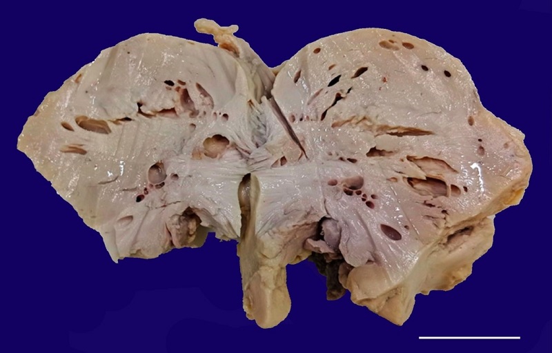 Gross specimen revealing marked cortical atrophy with spongiform appearance of white matter predominantly (scale bar = 5 cm).