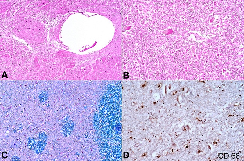 Photomicrographs of the central nervous system. A &ndash; demonstrates spongiform/vacuolar degeneration of the white matter in a background of reactive gliosis and infarct necrotic areas (H&E, 100x); B &ndash; shows numerous axonal spheroids, and macrophages infiltration in the degenerated cystic parenchyma (H&E, 400x); C &ndash; Luxol-Fast Blue (LFB) stain revealing rarefaction of myelinated nerve fibers (200x); D &ndash; CD68 IHC stain highlighting the macrophages (400x).