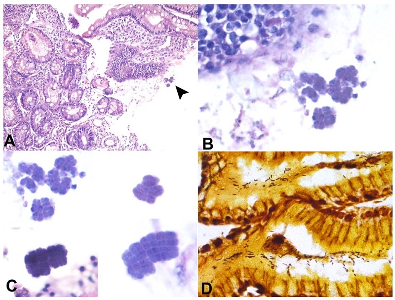 A - Photomicrograph from gastric biopsy shows gastric glands with intermixed chronic inflammatory cell infiltrate and presence of bacterial clumps (H&E, 100X); B - Higher magnification shows the presence of Clostridium ventriculi (H&E, 400X); C - Photomicrograph shows different forms of Clostridium ventriculi like tetramers, octamers (H&E, 1000X); D - Special stain for Warthin-starry highlights the Helicobacter pylori co-infection (400X).