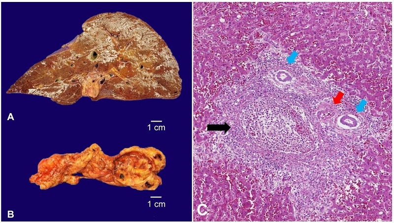 A - Gross examination of the congested and friable liver (weight: 2789,0 g); B - Gallbladder with chronic inflammation due to calculi; C - Photomicrograph of the liver shows portal venulitis, with a suppurative inflammatory reaction and fibrin (black arrow), sparing the biliary tract (blue arrow) and the hepatic artery (red arrow) (H&E, 400X).
