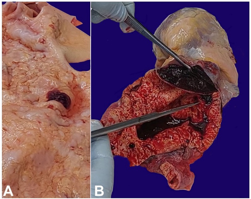 A - shows the intima of the saccular aneurysm with the intimal tear (hemorrhagic area), and the wrinkling of the intima (tree barking phenomenon); B - shows a saccular aneurysm with dissection between the intima and the media, and deposits of atheroma with wrinkling of the intima giving rise to the tree bark-like appearance.