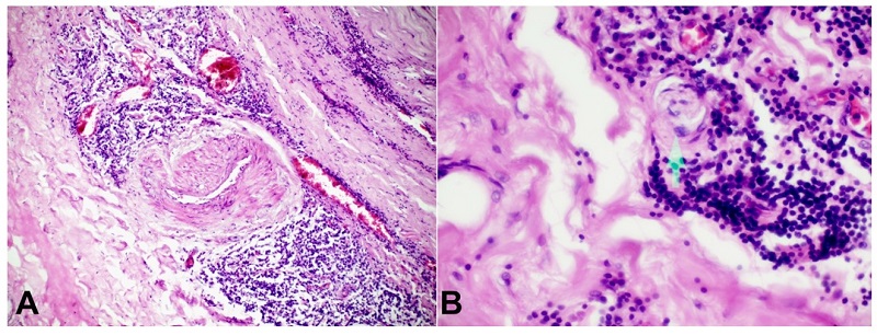 A - shows chronic inflammation mainly of lymphocytes and plasma cells around the vasa vasorum, extending to numerous capillaries. There is also fibrosis of the media (H&E 10x40); B - shows Endarteritis Obliterans (H&E 10 X 40).