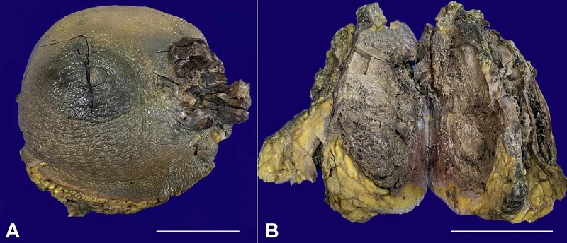 Gross view of the surgical specimen. A - Left mastectomy specimen showing a fungating ulcer on the lateral aspect (scale bar= 10 cm); B - Cut section shows a large fleshy dark brown to tan tumor occupying almost the entire breast (scale bar = 10 cm).