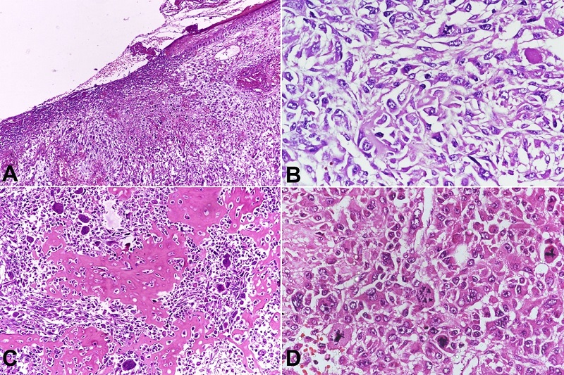 Photomicrographs of the tumor. A - Tumor arranged in diffuse sheets with overlying ulcerated skin (H&E,10x); B - Tumor cells with moderate eosinophilic cytoplasm, pleomorphic nuclei, coarse chromatin and prominent nucleoli (H&E,40x); C - Numerous osteoclast type giant cells intermingling with areas of osteoid (H&E,20x); D - Atypical mitotic figures (H&E, 20x).