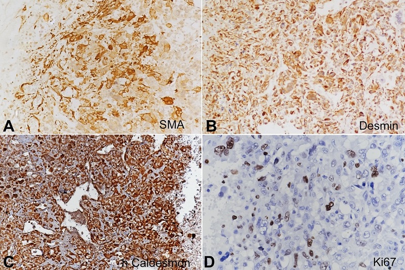 Photomicrographs of the tumor. Immunohistochemical stains. A - positive Smooth Muscle Actin (20x); B - positive Desmin (20x); C - positive h-Caldesmon (20x); D - Ki67 -15% (20x).