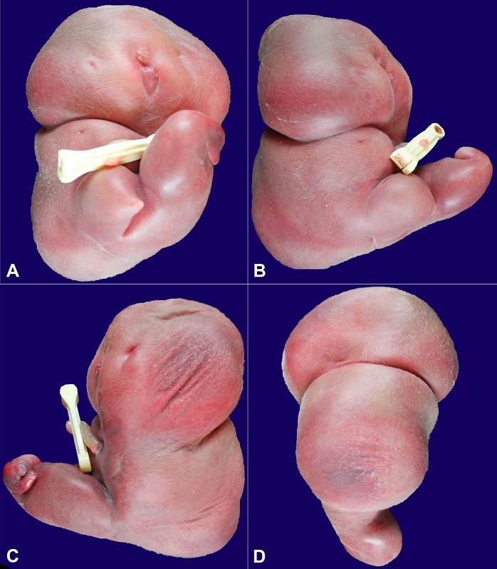 External examination of the acardiac twin with severe fetal hydrops. A - Anterior view showing lack of mature midline facial structures with blind-ended primitive oral cavity; B - Right lateral view demonstrating complete absence of right upper extremity and distal right lower extremity; C - Left lateral view demonstrating complete absence of left upper extremity and rudimentary left lower extremity; D - Posterior view demonstrating lack of rectoanal structures.