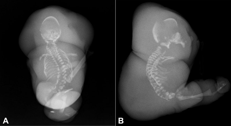 Postmortem Xray. A - AP view; B - lateral view demonstrating hypoplasia of the appendicular skeleton, small, malformed cranium, and thoracolumbar scoliosis with multiple vertebral anomalies.
