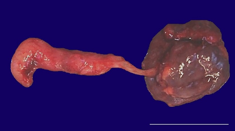 Gross appearance of anomalous cloaca-like structure consisting of a tubular structure which was contiguous with the renal collecting system (scale bar= 2.0 cm).