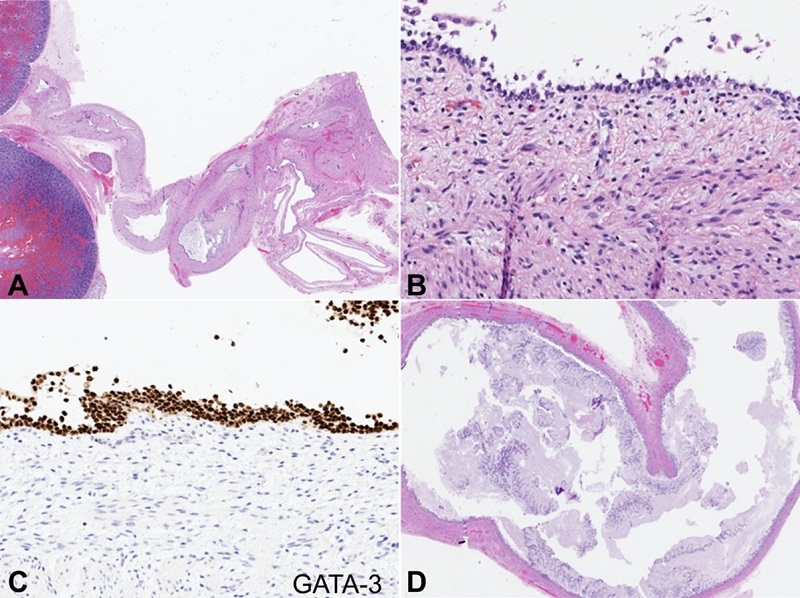 Microscopic appearance of anomalous cloaca-like structure. A - The cloaca-like structure was contiguous with the renal collecting system (H&E stain, 10x); B - The proximal segment was lined by urothelium (H&E stain, 380x); C - The proximal segment demonstrated strong GATA-3 expression by immunohistochemistry (360x); D - The mid-segment was lined by intestinal epithelium (H&E stain, 25x).