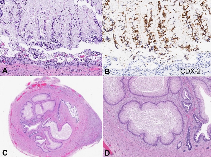 - Microscopic appearance of anomalous cloaca-like structure. A - The mid-segment was lined by intestinal epithelium (H&E stain, 250x); B - The mid-segment demonstrated strong CDX-2 expression by immunohistochemistry (250x); C and D - The distal segment was lined by stratified squamous epithelium (H&E stain, 40x and 200x).