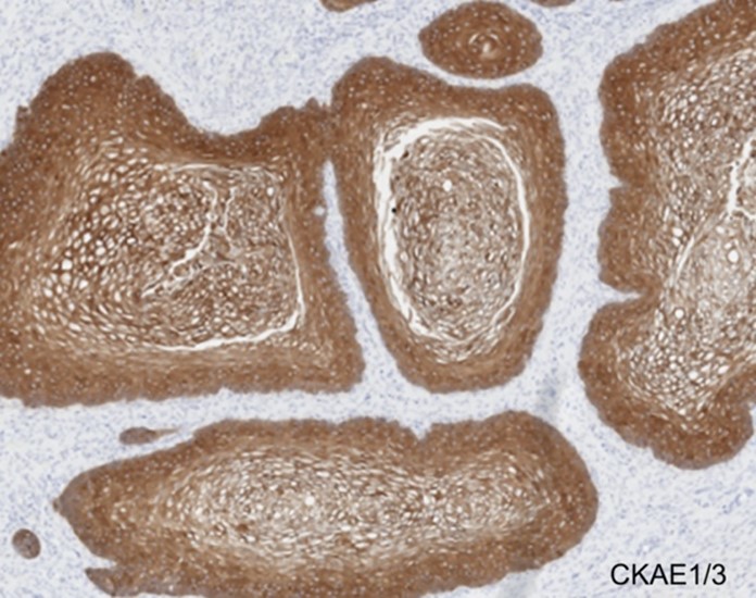 Microscopic appearance of anomalous cloaca-like structure. The stratified squamous epithelium demonstrated only strong CKAE1/3 expression by immunohistochemistry (200x).