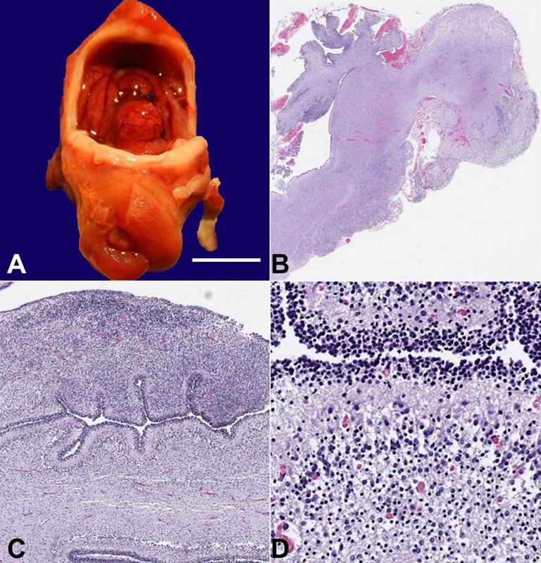 Neuropathology. A - In-situ examination of the brain revealed a rudimentary brainstem, hypoplastic cerebellum, and complete absence of the cortical hemispheres (scale bar= 1.0 cm); B - Whole mount of the rudimentary brainstem with hypoplastic cerebellum (H&E stain, 20x); C and D - Immature cerebellum with external granular, molecular, Purkinje, and internal granular layers (H&E stains, 230x and 350x).