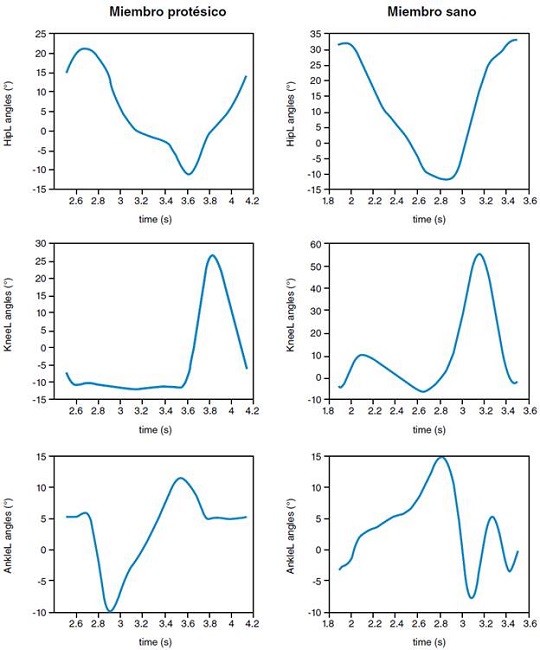 Ejemplo de valores angulares en función del tiempo obtenidos para lado sano y protetizado durante un ciclo a velocidad lenta.