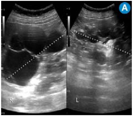 Enfermedad renal poliquística dominante en paciente trasplantado. A) Ecografía renal: múltiples imágenes quísticas que comprometen el parénquima renal bilateral. Continúa.