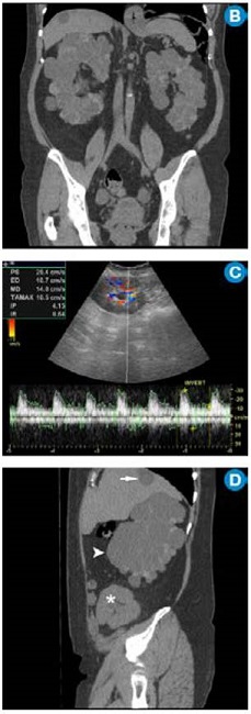 B) CT simple corte coronal: riñones aumentados de tamaño con múltiples quistes. C) Ecografía doppler color: riñón trasplantado sin alteraciones. D) CT simple corte sagital: riñón trasplantado (asterisco), riñón derecho con múltiples quistes (cabeza de flecha) y quiste hepático (flecha). Continúa.