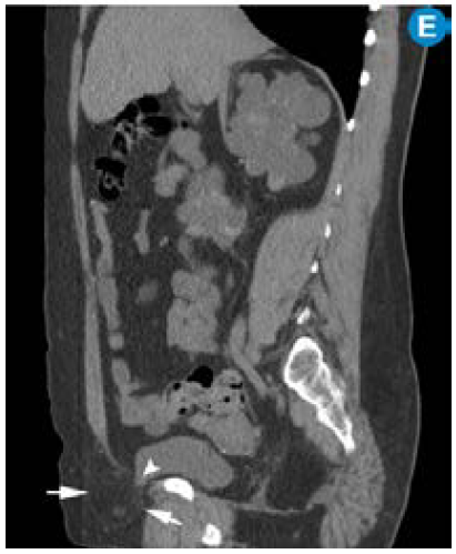 E) CT simple corte sagital: hernia inguinal directa derecha (entre flechas) con pequeña porción de la vejiga dentro del saco herniario (cabeza de flecha).