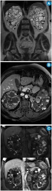 Enfermedad renal poliquística dominante en paciente trasplantado. A) MR coronal T2. Se observan los ríñones aumentados de tamaño con múltiples quistes con diferentes intensidades de señal por contenido hemático en diferentes fases. B) MR axial T1 fatsat con contraste: el aumento de la intensidad de señal de los quistes es secundario al contenido hemático. C) MR coronal T1 fatsat simple (arriba) y contrastado (abajo): se nota la ausencia de realce de las lesiones quísticas que confirma el hallazgo. Continúa.