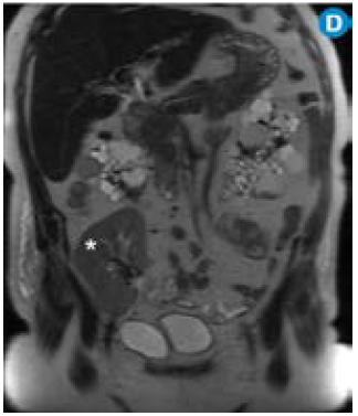 D) MR coronal T2: se observa el riñón trasplantado (asterisco). 