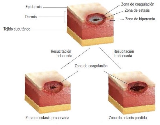Zonas histológicas de la quemadura.