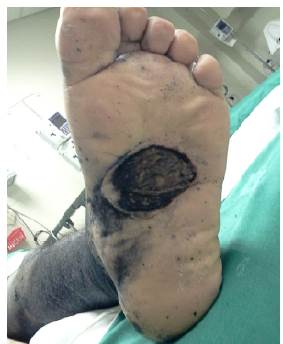 Lesión primaria ulcerada de cerca de 3cm, hiperpigmentada y de bordes mal definidos en pie izquierdo.