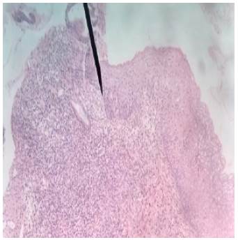 Melanoma lentiginoso acral con Breslow de 2.33mm con epidermis atrófica, proliferación de melanocitos en capa basal y presencia de atipia nuclear y mitosis. Tinción: Hematoxilina-Eosina. Vista: 40x.