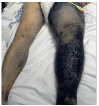 Tumefacción de miembro inferior izquierdo, piel negruzca, acartonada y con múltiples formaciones nodulares que recorren la extremidad de forma ascendente (metástasis en tránsito).