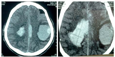 Tomografía axial computada, lesión metastásica cerebral.