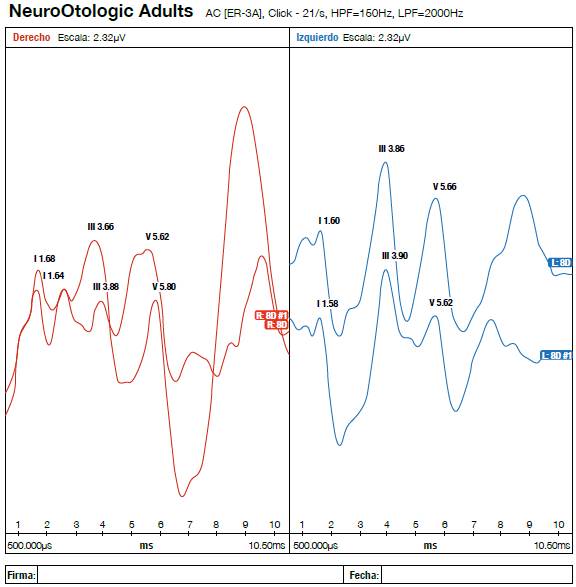 Registro de potenciales evocados auditivos de tronco cerebral del sujeto en estudio.