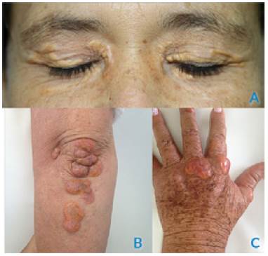 Paciente 1. A) Xantelasmas; B) xantomas en codo; C) xantomas en mano.
